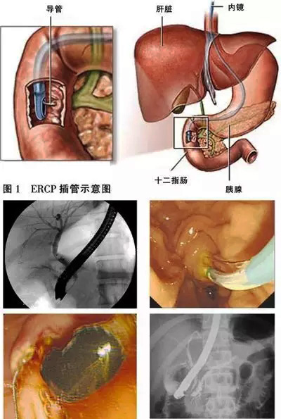 ERCP