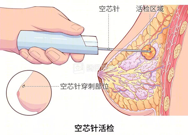 “活检”是什么?怎么做? “活检”是什么?怎么做?