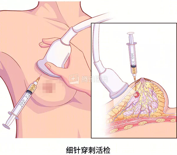 “活检”是什么?怎么做? “活检”是什么?怎么做?