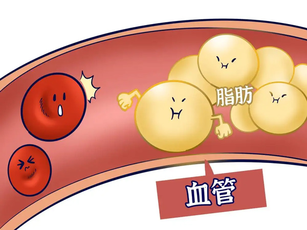 【心脑血管疾病防治行动】这些高血脂的误区你中了几个? 【心脑血管疾病防治行动】这些高血脂的误区你中了几个?