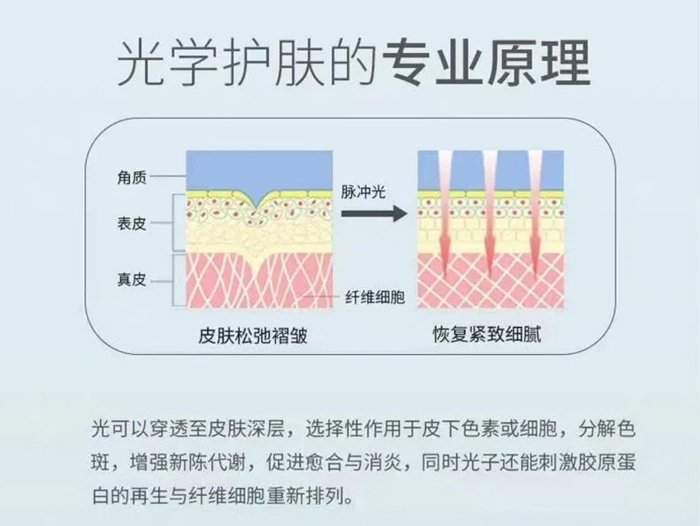 光子嫩肤怎么做?爱美的你要注意这几点~ 光子嫩肤怎么做?爱美的你要注意这几点~