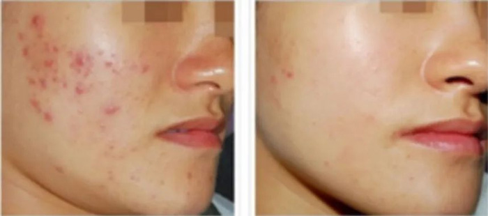 光子嫩肤怎么做?爱美的你要注意这几点~ 光子嫩肤怎么做?爱美的你要注意这几点~